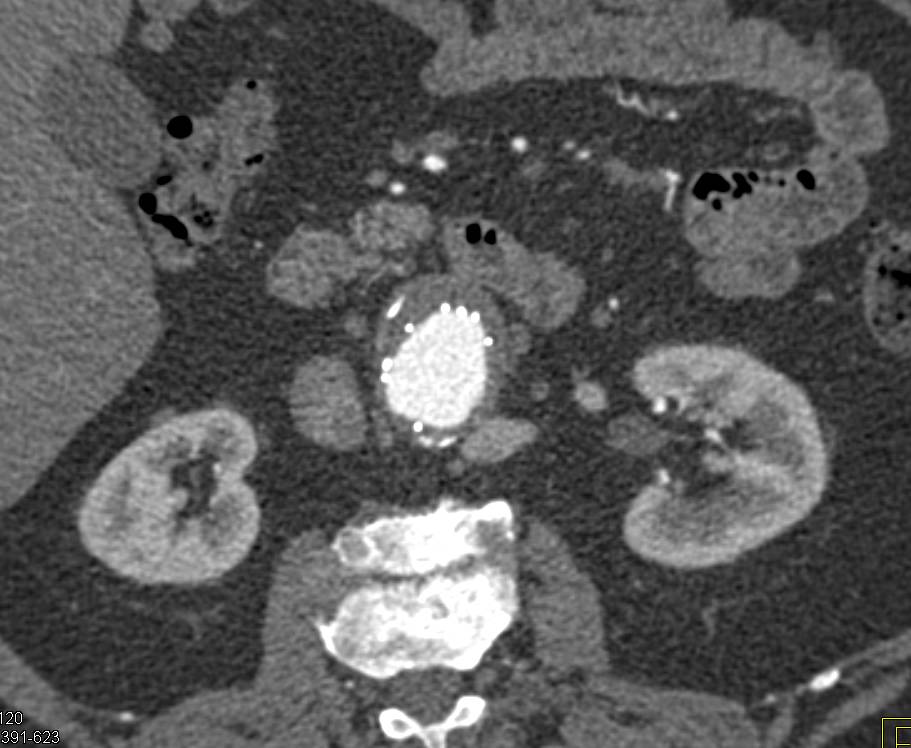 3D Mapping of an Endovascular Stent in the Abdominal Aorta - CTisus CT Scan