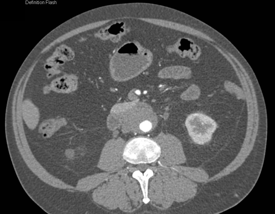 Retroperitoneal Fibrosis Involves Aorta and Ureters - CTisus CT Scan