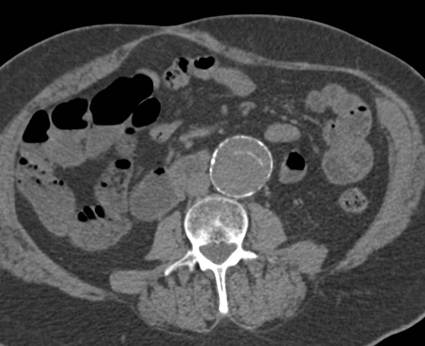 Aortic Dissection Extends into the Superior Mesenteric Artery (SMA) with a Stent in SMA - CTisus CT Scan