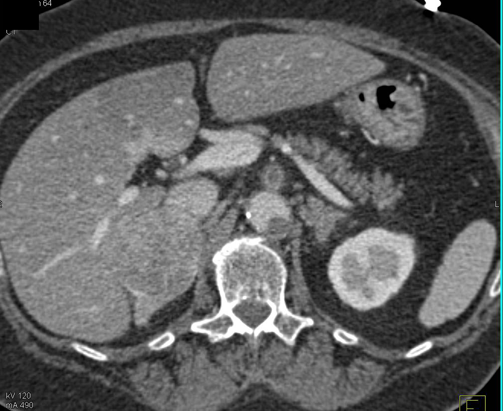 Superior Mesenteric Artery (SMA) Occlusion in Patient with Adrenal Tumor - CTisus CT Scan