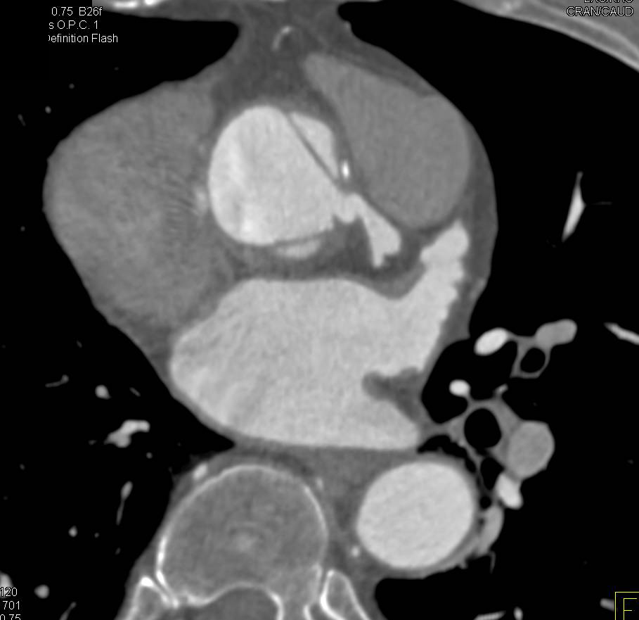 Type A Dissection in Patient with Aortic Valve Replacement - CTisus CT Scan