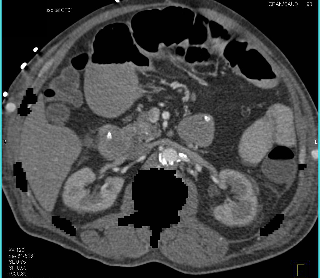 Bilateral Axillary to Superficial Femoral Artery (SFA) Grafts with Auto-Bone Removal - CTisus CT Scan