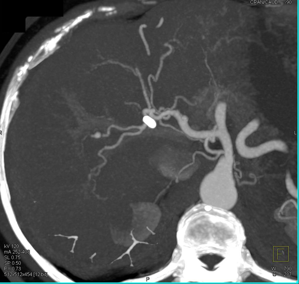 Hepatic Artery Pseudoaneurysm - CTisus CT Scan