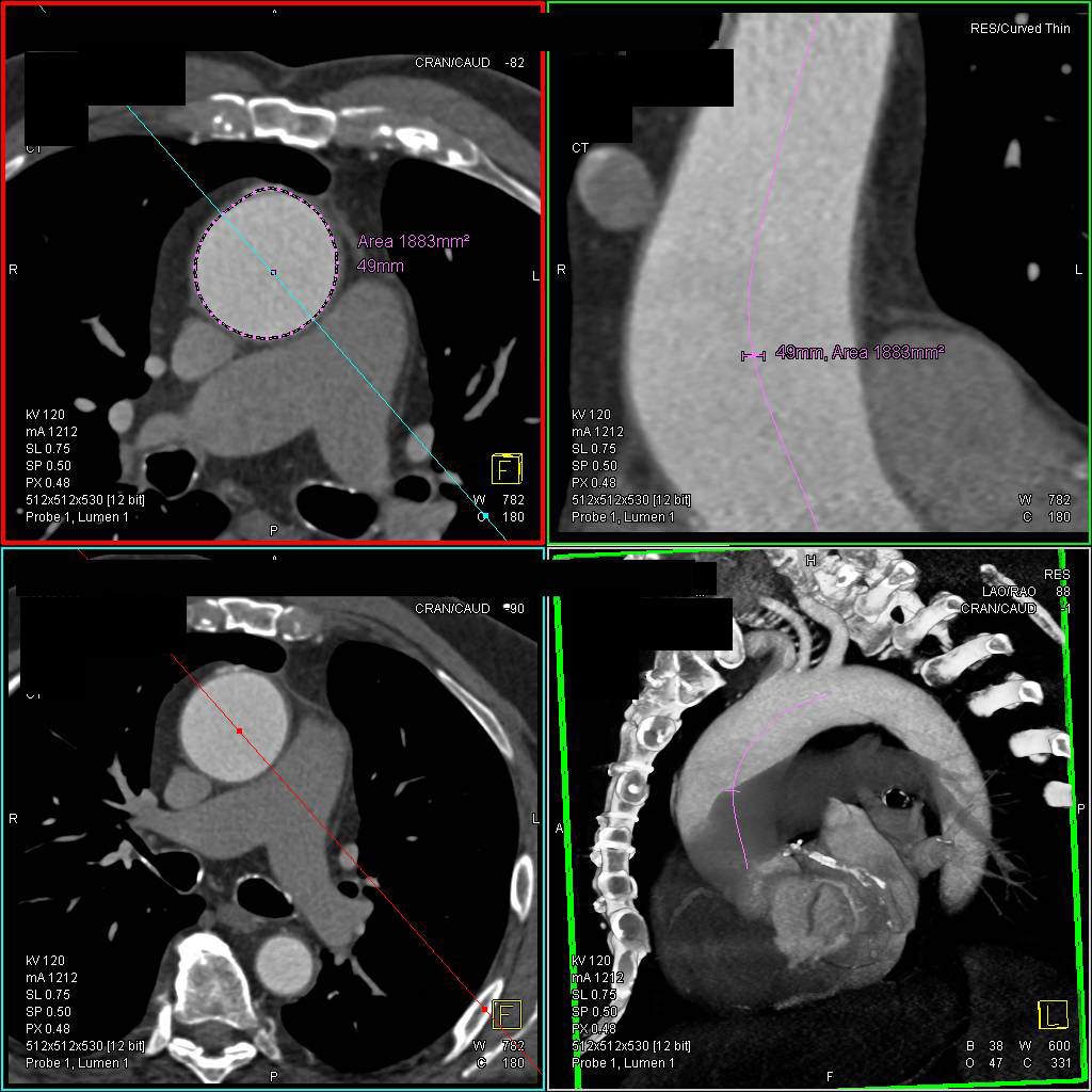 Dilated Aortic Root in Marfan Syndrome - CTisus CT Scan