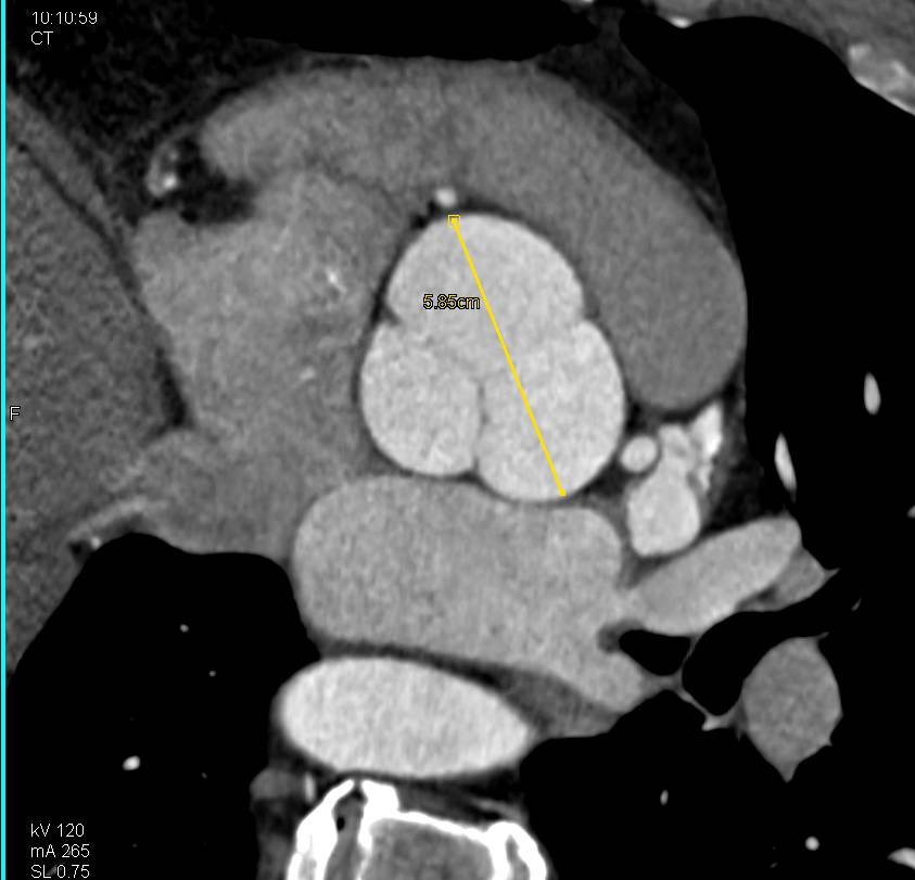 Dilated Aortic Root with Center Line Measurements - CTisus CT Scan