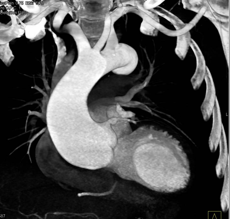 Marfan Syndrome with Dilated Root and Ascending Aorta - CTisus CT Scan