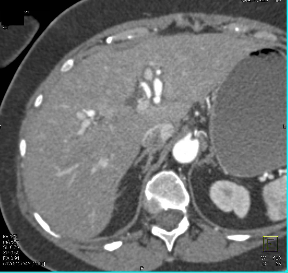 Multiple Hepatic Artery Aneurysms Possibly due to Vasculitis - CTisus CT Scan