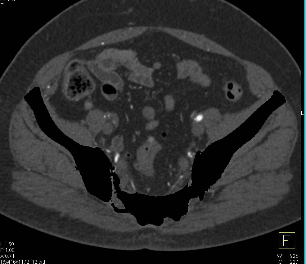 CTA with External Iliac and Superficial Femoral Artery (SFA) Disease seen on CTA - CTisus CT Scan
