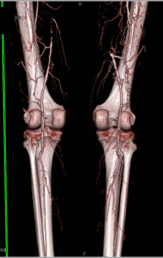 CTA with Dual Energy Runoff with Peripheral Vascular Disease (PVD) and Superficial Femoral Artery (SFA) Bilateral Occlusions - CTisus CT Scan