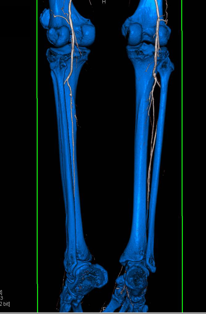 CTA Runoff with Peripheral Vascular Disease - CTisus CT Scan