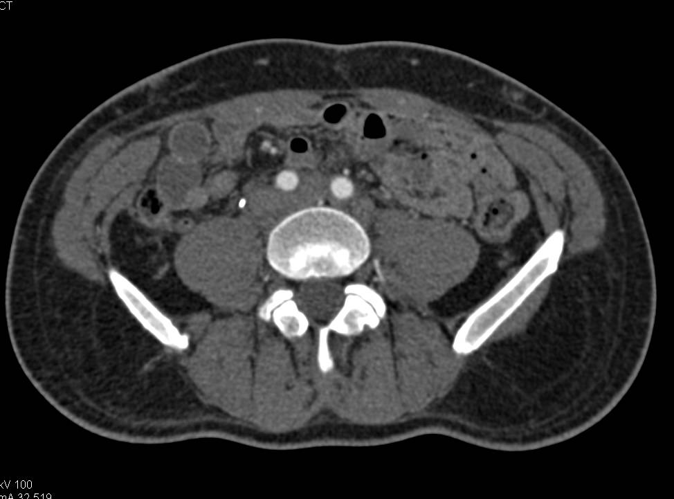 CTA Runoff with Right Venous Graft - CTisus CT Scan