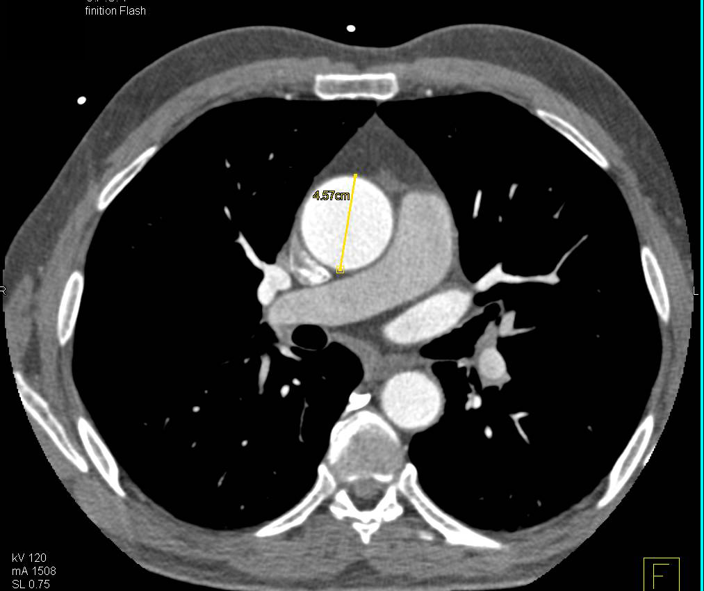 Dilated Aortic Root with Center Line Measurements - CTisus CT Scan