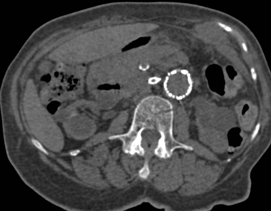 Superior Mesenteric Artery (SMA) and Celiac Artery Aneurysms in Patient with Endovascular Stent - CTisus CT Scan