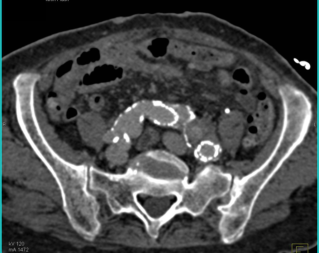 Endovascular Stent with low lying Endoleak - CTisus CT Scan