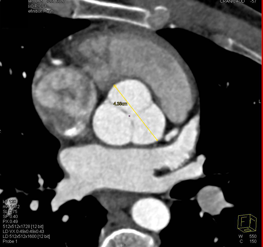 Dilated Aortic Root with Center Line Measurements - CTisus CT Scan