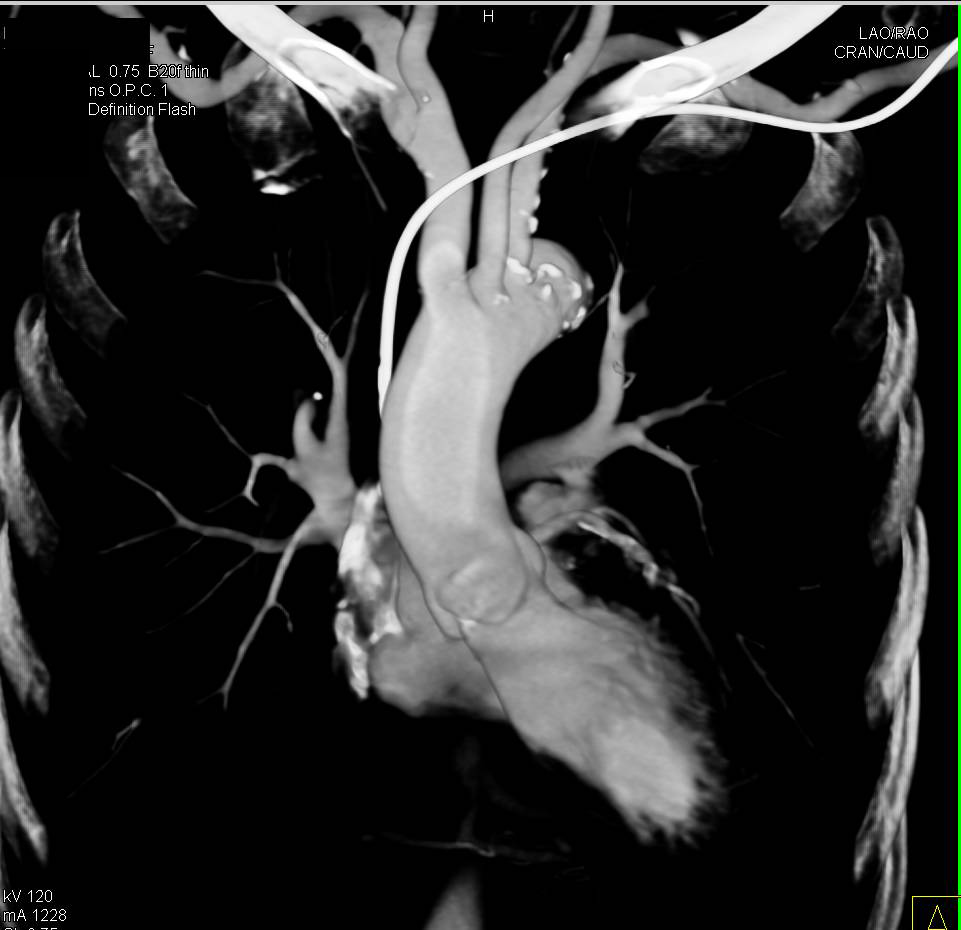 Atherosclerotic Disease with Superior Mesenteric Artery (SMA) Occlusion - CTisus CT Scan