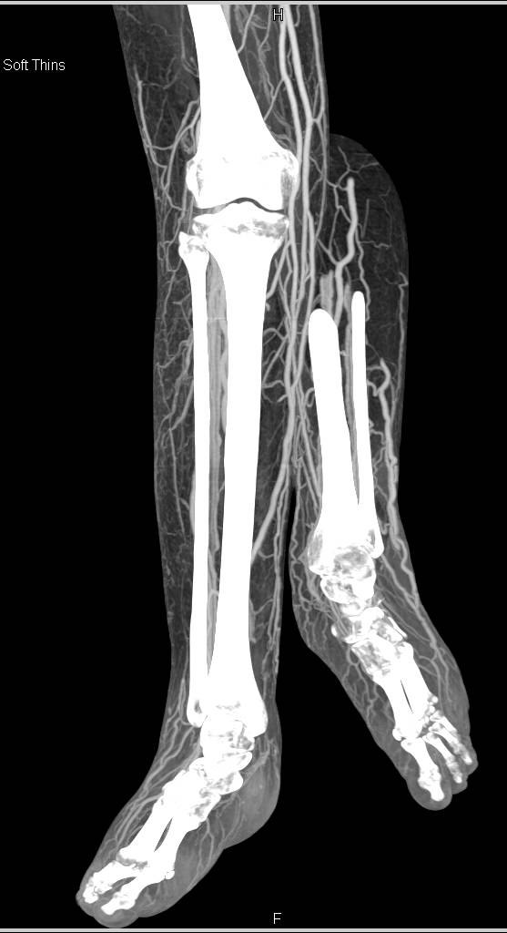 CTA Runoff with Arteries and Veins Using Dual Energy CT - CTisus CT Scan