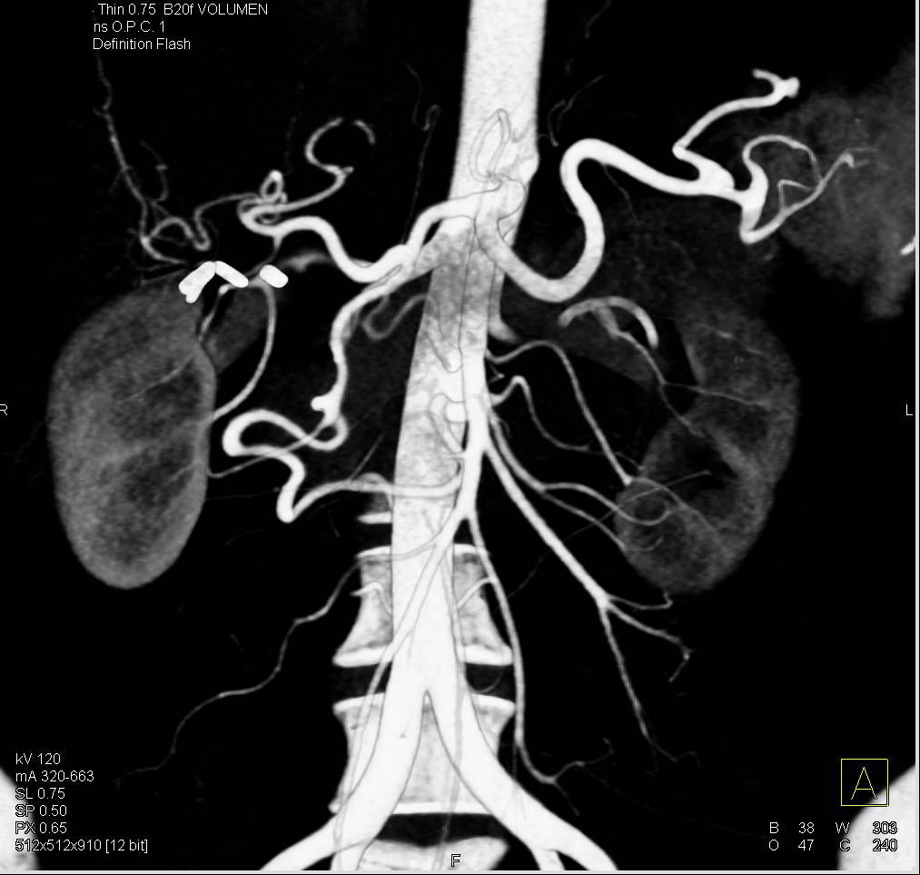 Celiac Artery Vasculitis Radiology
