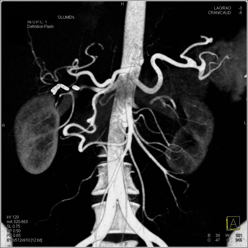 Stenosis Celiac Artery Origin With Flow Through Gastroduodenal Artery 