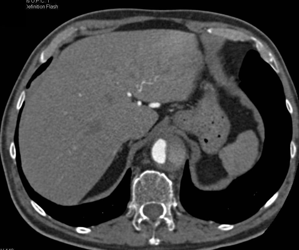 Abdominal Aortic Aneurysm with Dissection - CTisus CT Scan