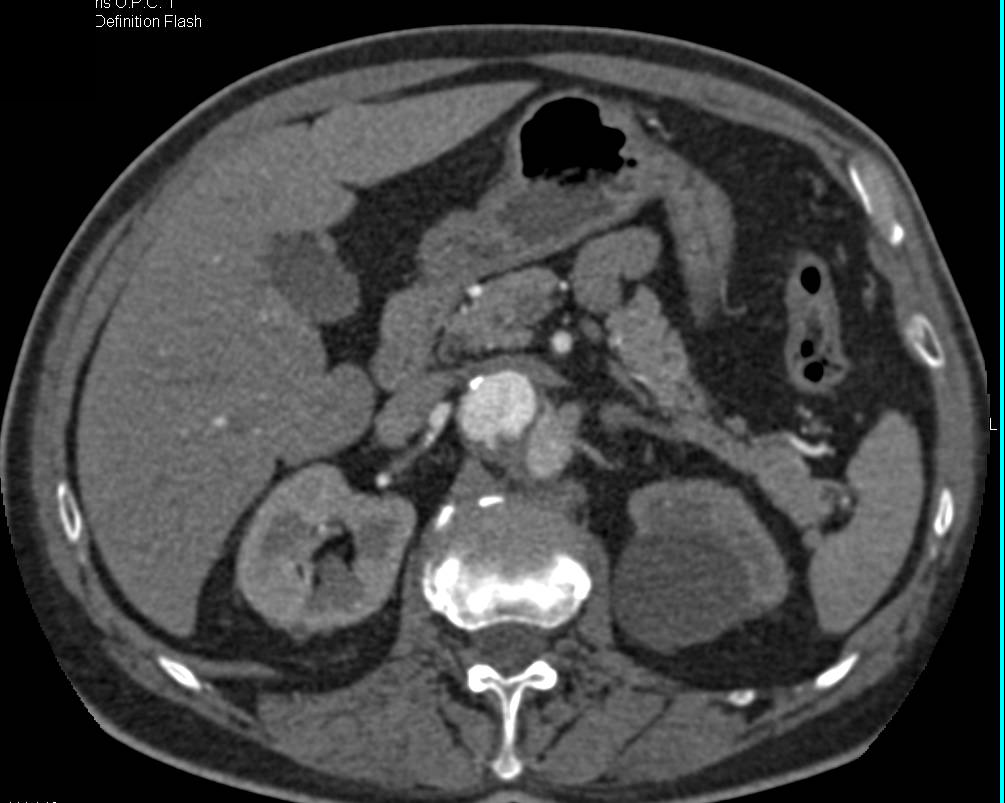 Aortic Dissection Near the Celiac Artery - CTisus CT Scan