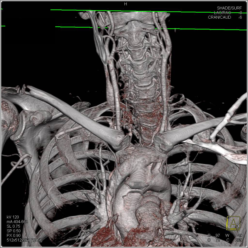 Occlusion of the Right Axillary Artery - CTisus CT Scan