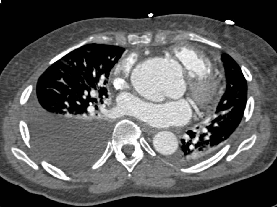 Type A Dissection - CTisus CT Scan