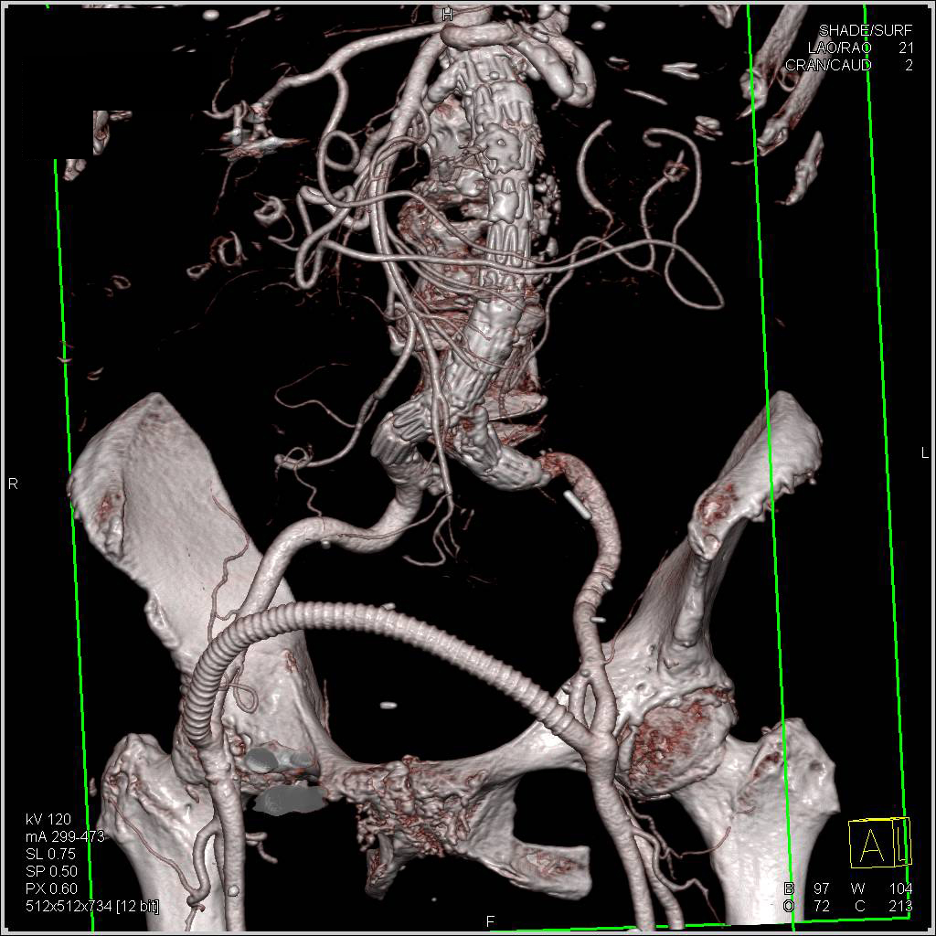 Endovascular Stent with Occlusion of Left Common Iliac Artery and Fem-Fem Bypass Graft - CTisus CT Scan