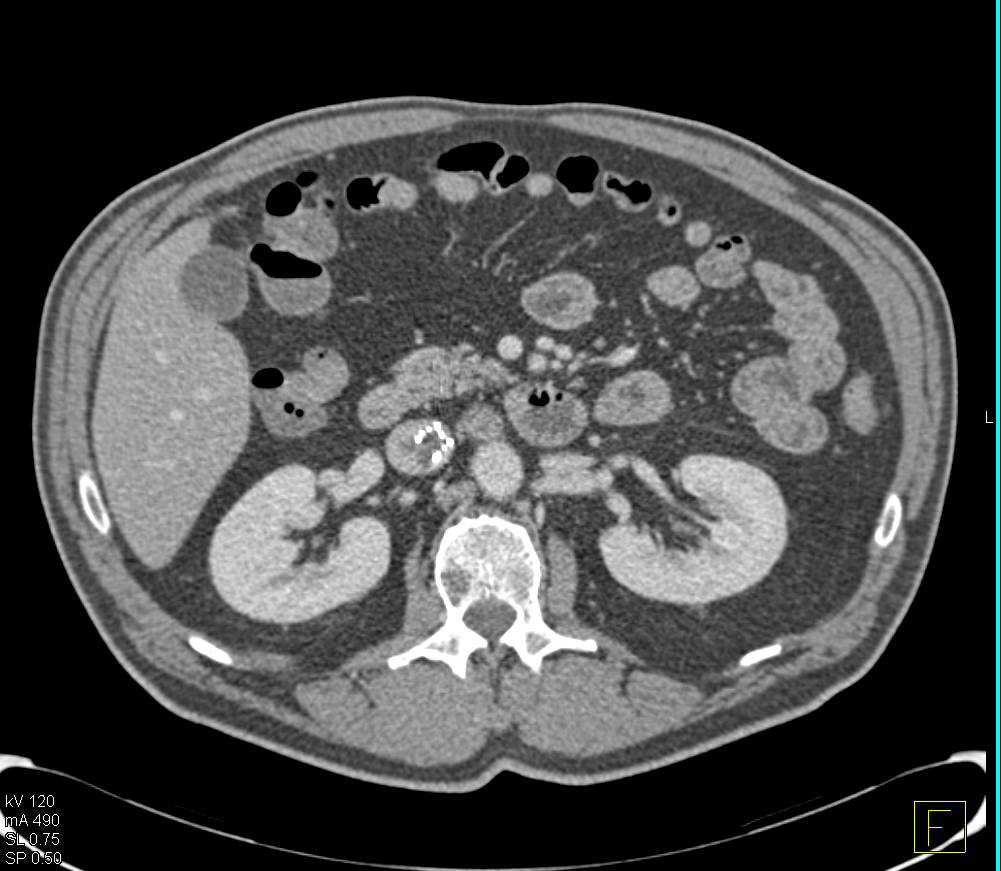 Inferior Vena Cava (IVC) Clot Near IVC Filter with Pulmonary Embolism (PE) and Liver Metastases - CTisus CT Scan