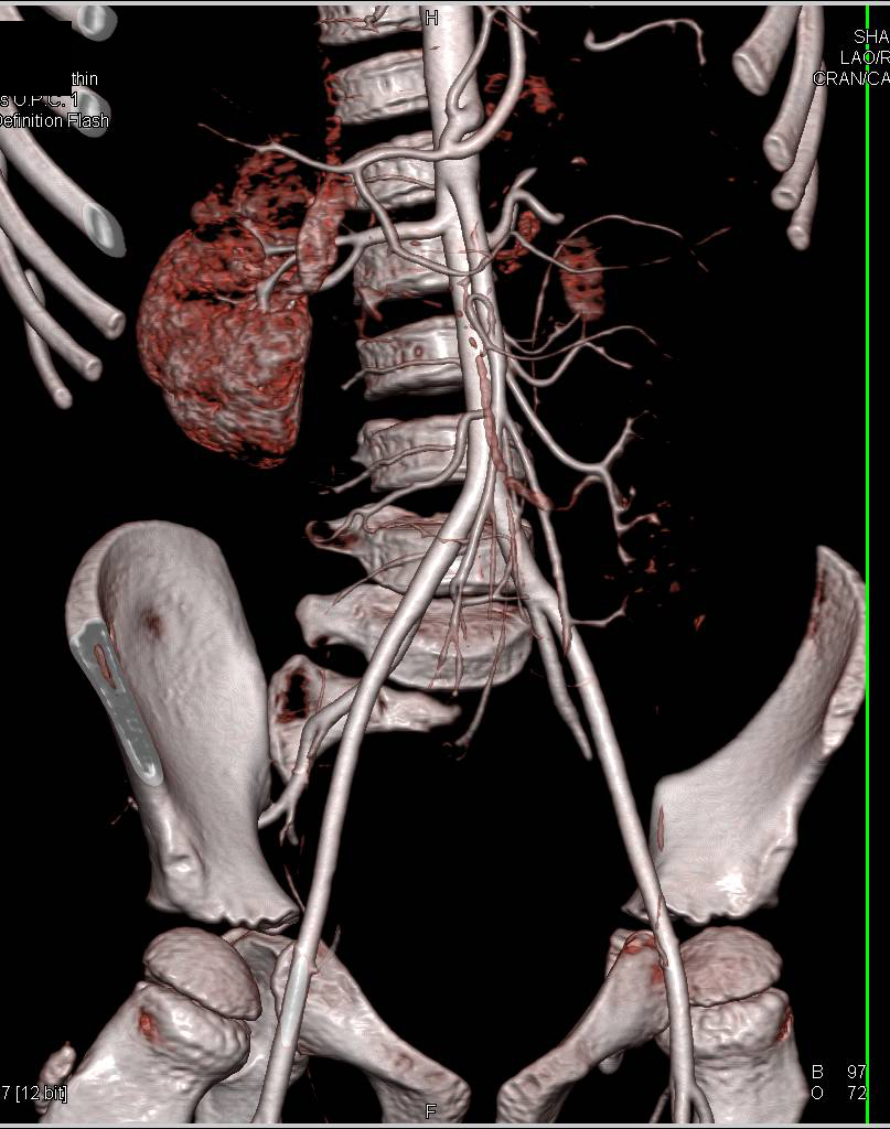 Loeys-Dietz Syndrome with Dilated Aortic Root - CTisus CT Scan