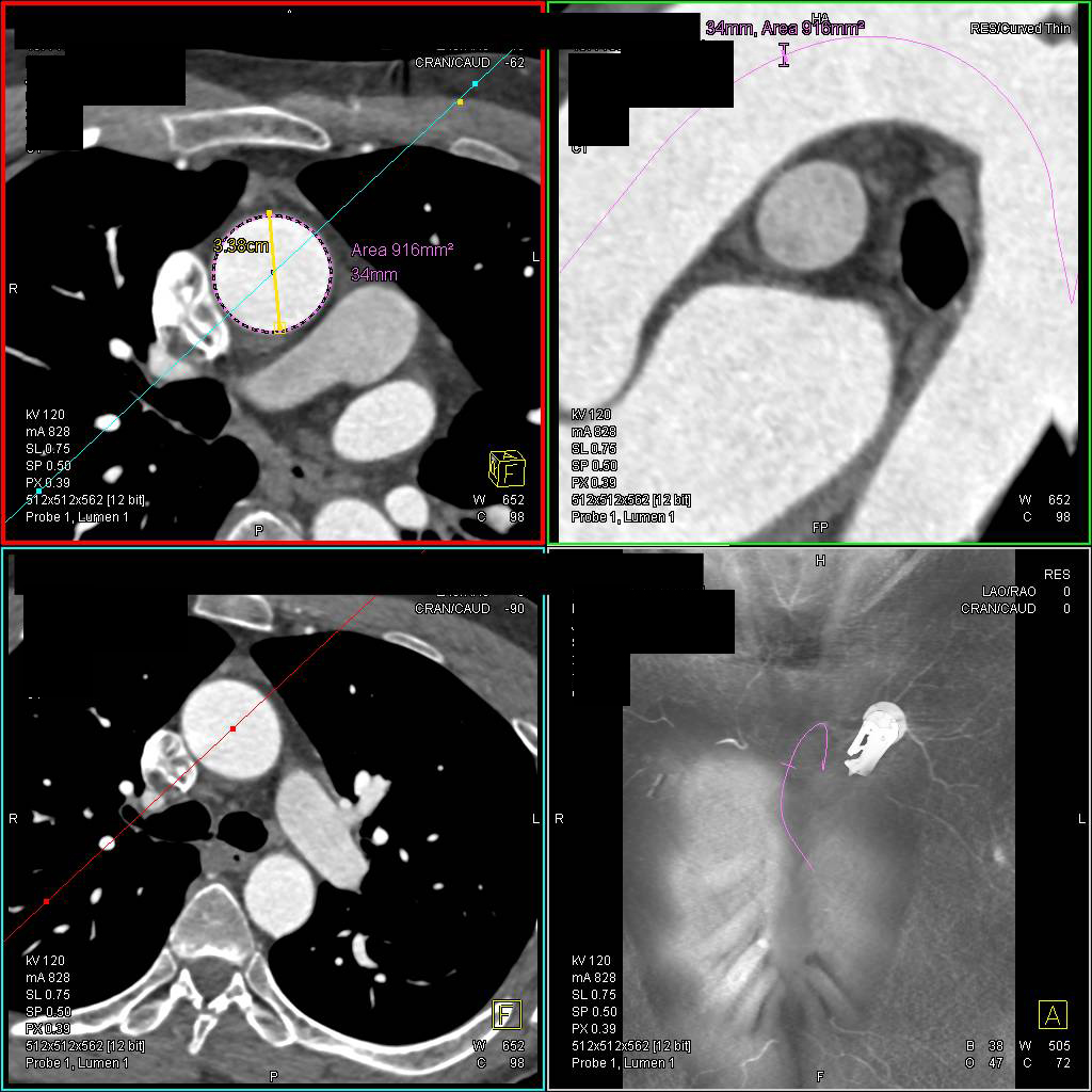 Dilated Aortic Root in Marfan Syndrome - CTisus CT Scan