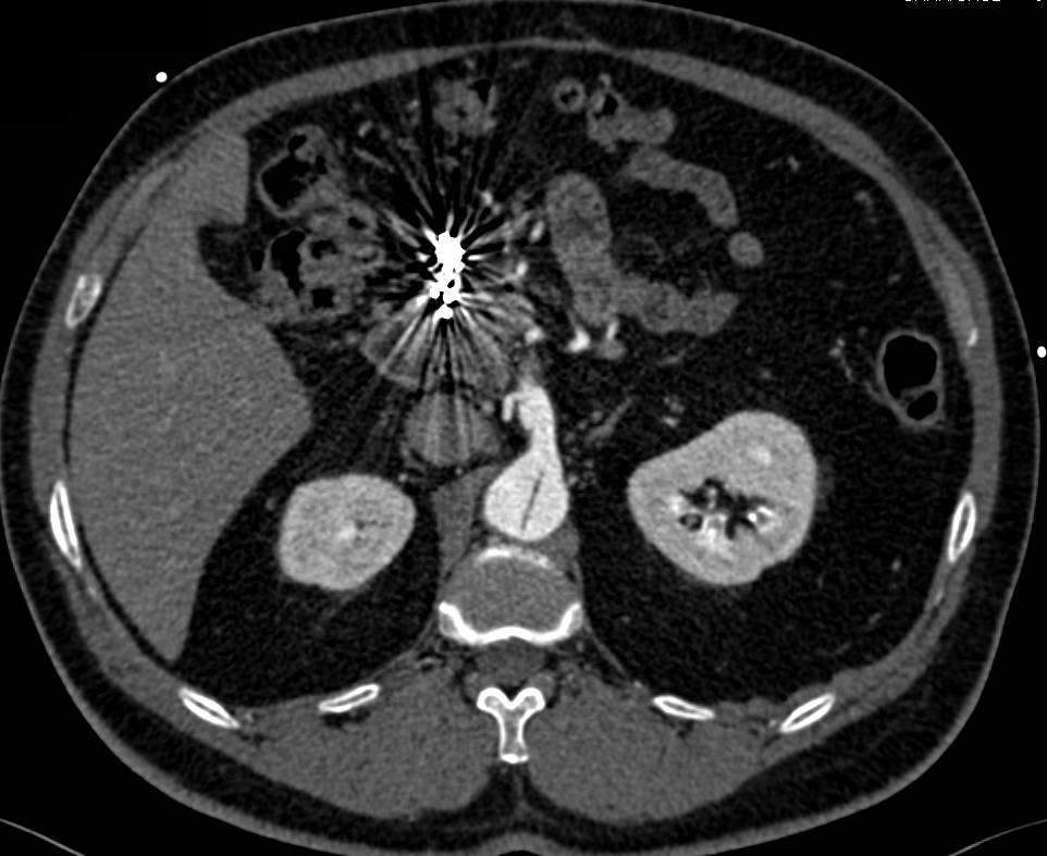 Ehlers-Danlos with Vasculitis of Mesenteric Arteries and Aortic Dissection - CTisus CT Scan