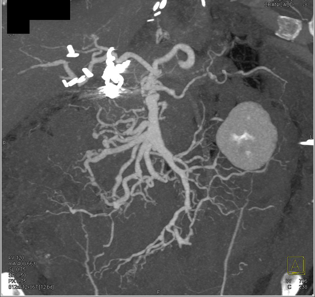 Aortic Dissection plus Vasculitis of Superior Mesenteric Artery (SMA) in Ehlers-Danlos Syndrome - CTisus CT Scan