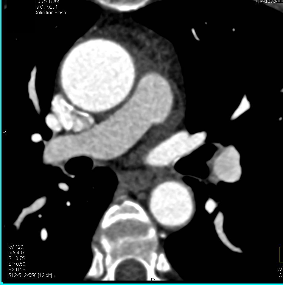 Dilated Aortic Root in Marfan Syndrome - CTisus CT Scan