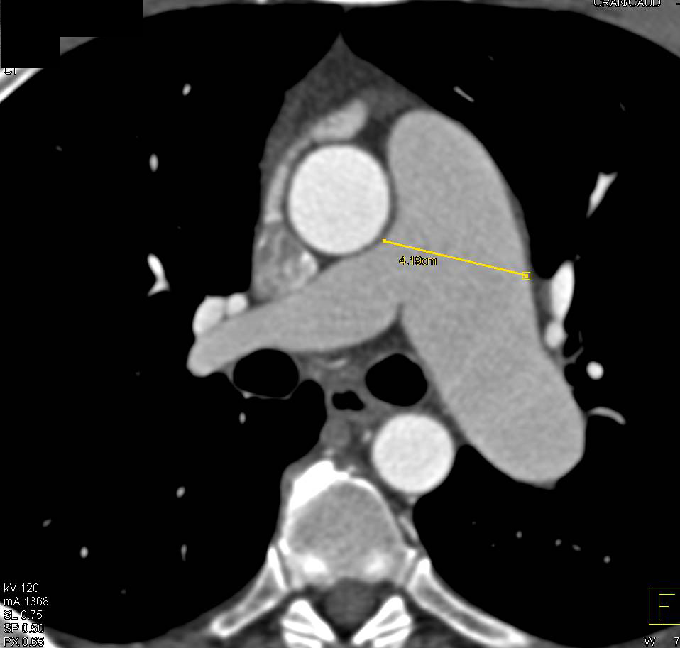 Dilated Left Main Pulmonary Artery - CTisus CT Scan