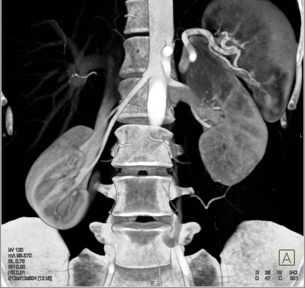 Superior Mesenteric Artery (SMA) Syndrome - CTisus CT Scan