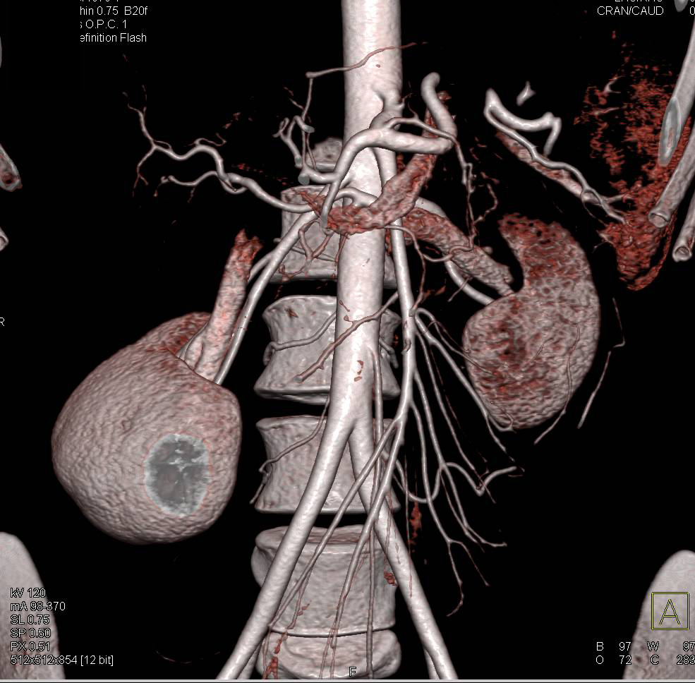SMA Syndrome - Vascular Case Studies - CTisus CT Scanning
