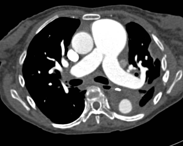 Repair of Aortic Aneurysm with Re-implanted Vessels in Upper Abdominal Aorta - CTisus CT Scan