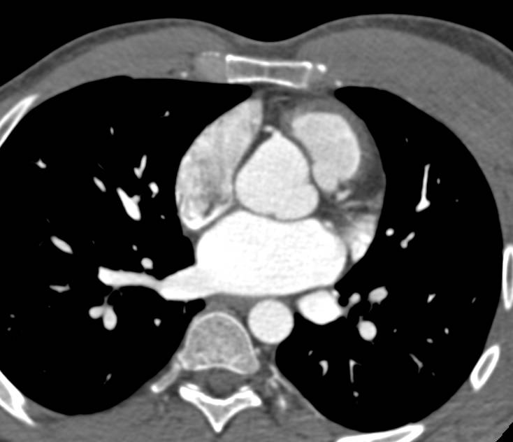 Median Arcuate Ligament Syndrome with Narrowed Celiac Artery - CTisus CT Scan