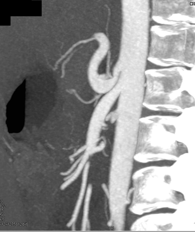 Median Arcuate Ligament Syndrome with Narrowed Celiac Artery - CTisus CT Scan