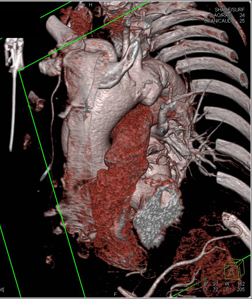 Ductus Aneurysm and Ulcerating Plaque Descending Thoracic Aorta - CTisus CT Scan