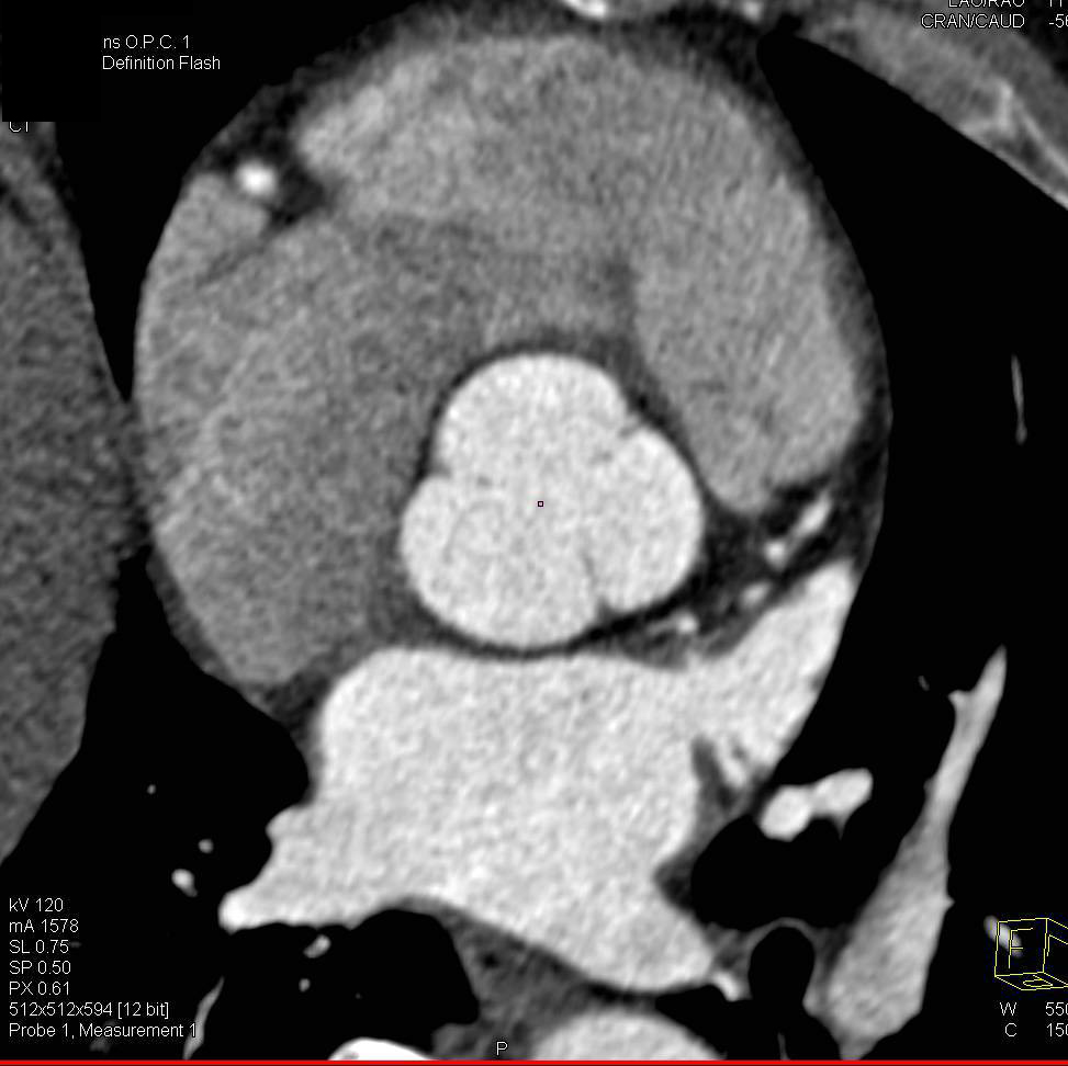 Dilated Aortic Root with Vessel Tracking - CTisus CT Scan