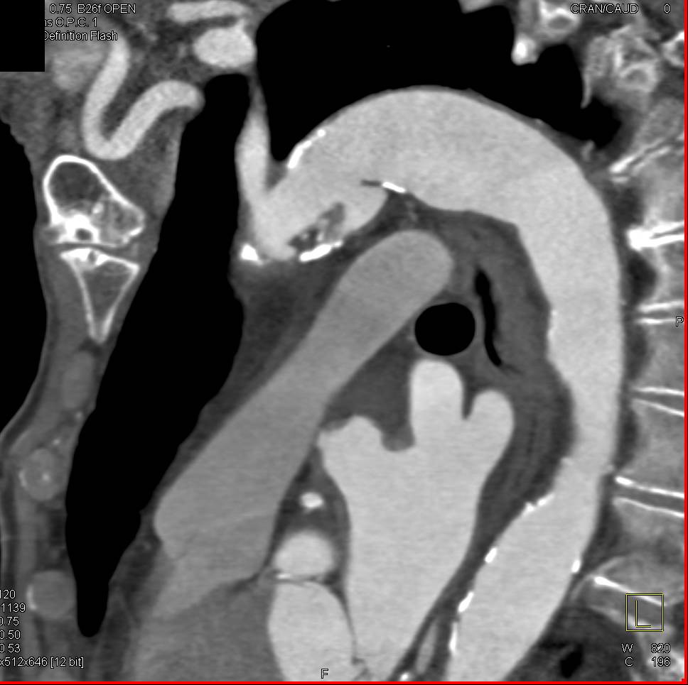 Focal Type B Dissection - CTisus CT Scan