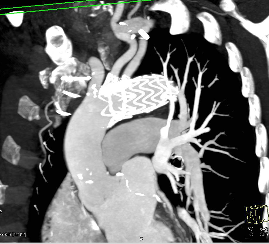 Endovascular Stent with Repair of Arch and Stent Placed in the Left Carotid Artery - CTisus CT Scan