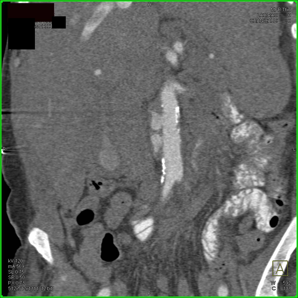 Multiple Ulcerations in the Abdominal Aorta - CTisus CT Scan