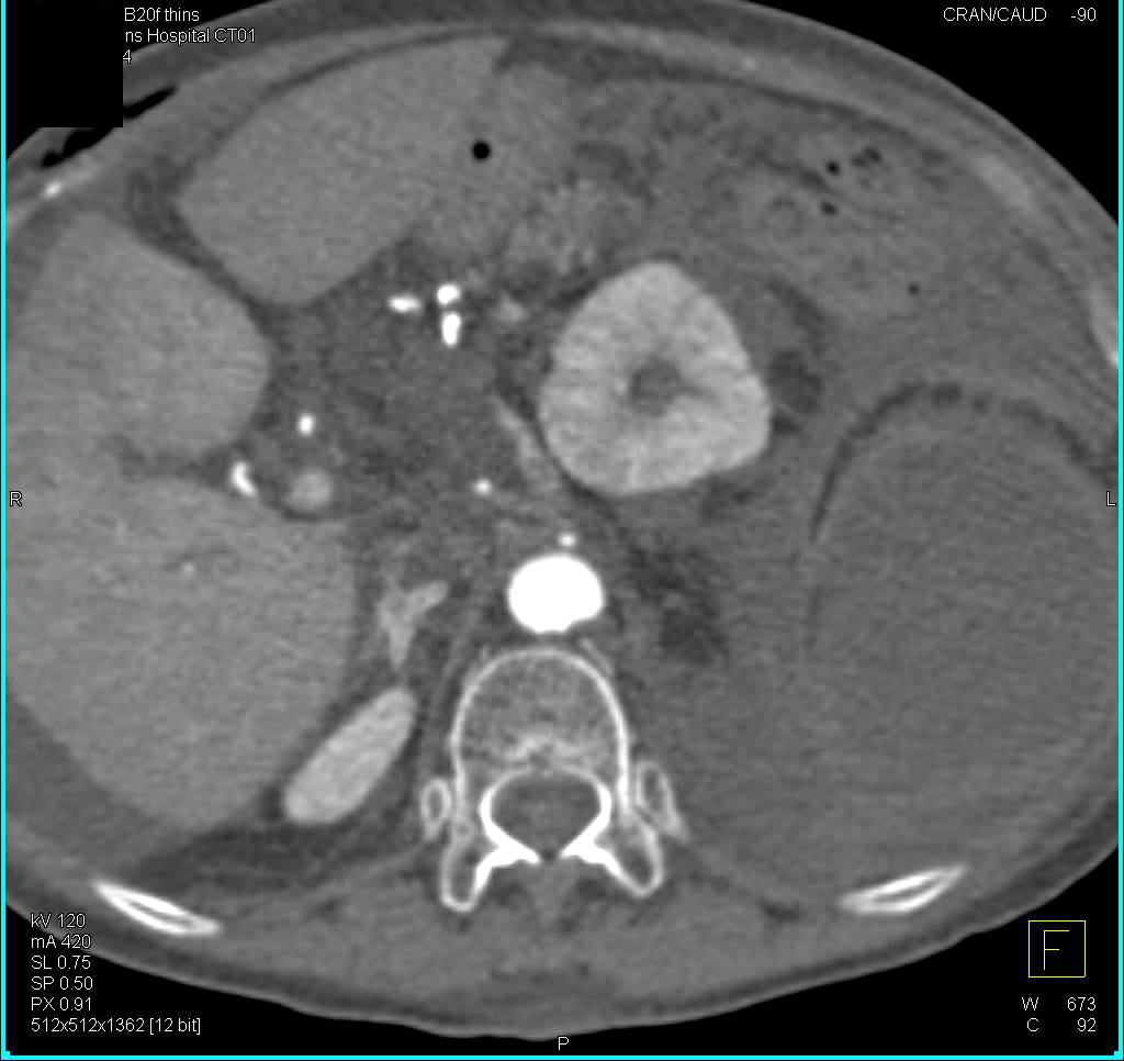 Left Sided Hematoma due to Aneurysm Leakage in 3D - CTisus CT Scan