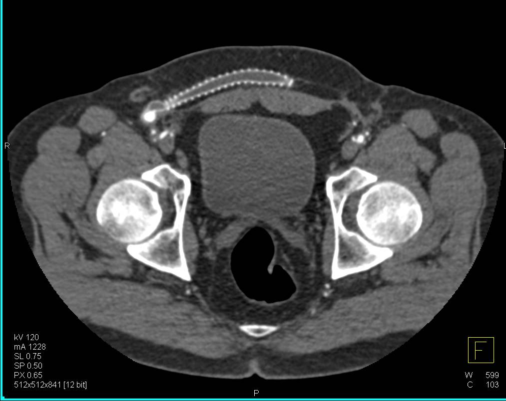 Extensive Vascular Disease with Occluded Fem-Fem Bypass Graft - CTisus CT Scan