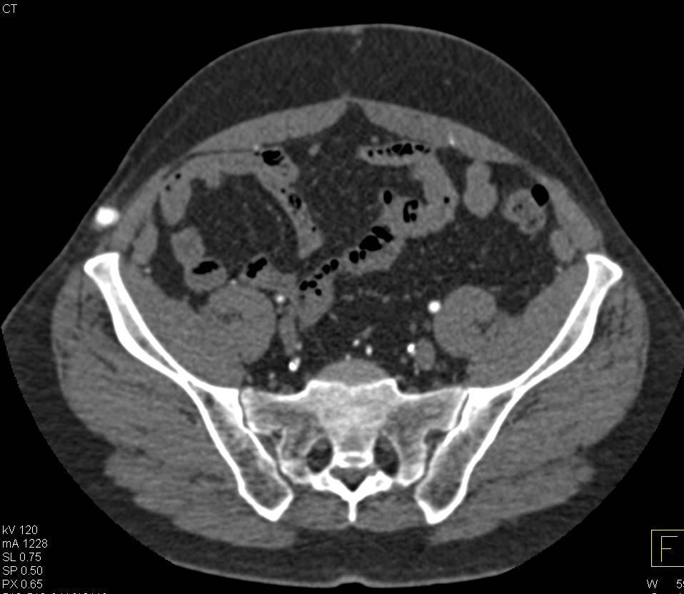 Reconstructed Aorta with Grafts and Stents - CTisus CT Scan