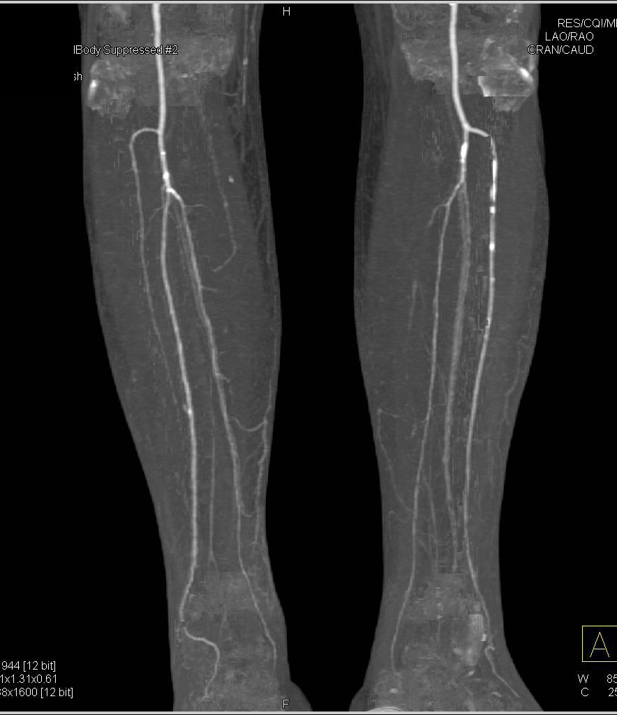 Severe Peripheral Vascular Disease (PVD) with Dual Energy and Single Energy Edited Images - CTisus CT Scan