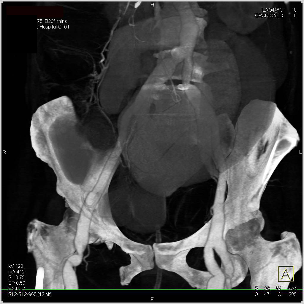 Mesenteric Aneurysms with Ischemic Bowel in Vascular Ehlers-Danlos Syndrome - CTisus CT Scan